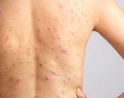 ACNE DOS HOMME BLANC ACNE DOS HOMME BLANC
