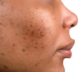 ACNE FEMME NOIRE ACNE FEMME NOIRE