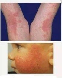 eczema-bb eczema-bb
