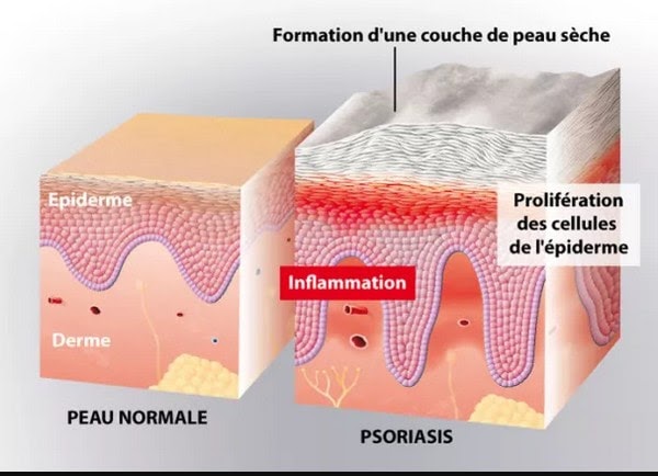 psoriasis-explications psoriasis-explications
