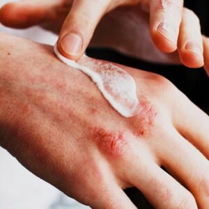 Crème cortisone verte