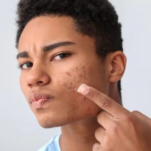 Crème visage anti-acné